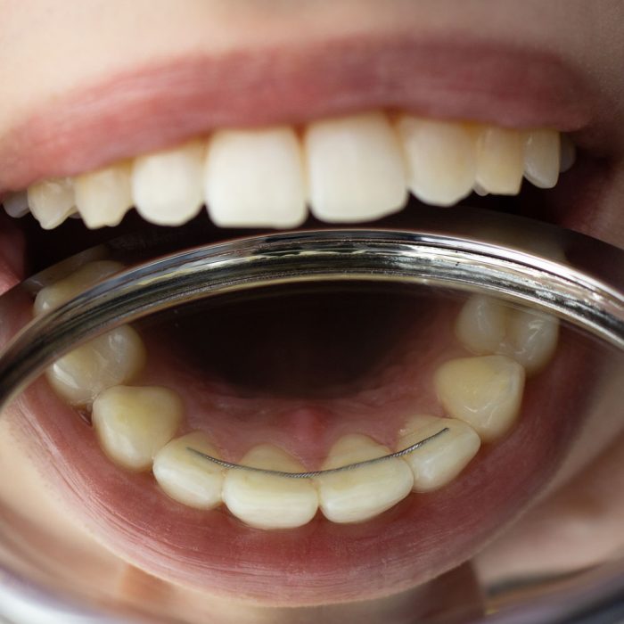Types of Retainers Reed Orthodontics