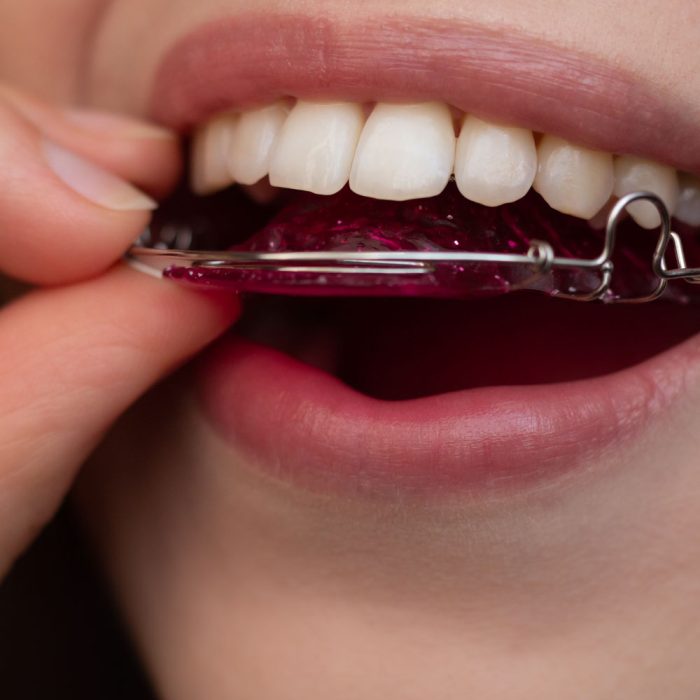 Types of Retainers Reed Orthodontics
